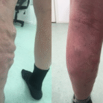 Anvend støttestrømper til forebyggelse af åreknuder